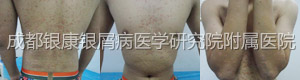 治疗前.jpg