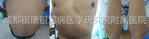 治疗中.jpg