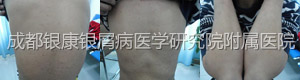 治疗后.jpg