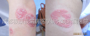 治疗前.jpg