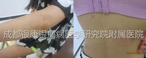 治疗后.jpg