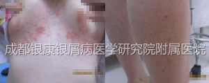 治疗前.jpg