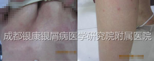 治疗后.jpg